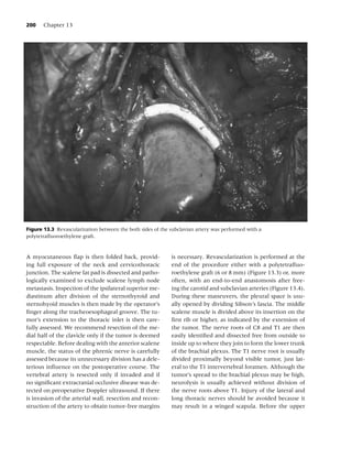 200    Chapter 13




Figure 13.3 Revascularization between the both sides of the subclavian artery was performed with a
polytetraﬂuoroethylene graft.


A myocutaneous ﬂap is then folded back, provid-             is necessary. Revascularization is performed at the
ing full exposure of the neck and cervicothoracic           end of the procedure either with a polytetraﬂuo-
junction. The scalene fat pad is dissected and patho-       roethylene graft (6 or 8 mm) (Figure 13.3) or, more
logically examined to exclude scalene lymph node            often, with an end-to-end anastomosis after free-
metastasis. Inspection of the ipsilateral superior me-      ing the carotid and subclavian arteries (Figure 13.4).
diastinum after division of the sternothyroid and           During these maneuvers, the pleural space is usu-
sternohyoid muscles is then made by the operator’s          ally opened by dividing Sibson’s fascia. The middle
ﬁnger along the tracheoesophageal groove. The tu-           scalene muscle is divided above its insertion on the
mor’s extension to the thoracic inlet is then care-         ﬁrst rib or higher, as indicated by the extension of
fully assessed. We recommend resection of the me-           the tumor. The nerve roots of C8 and T1 are then
dial half of the clavicle only if the tumor is deemed       easily identiﬁed and dissected free from outside to
respectable. Before dealing with the anterior scalene       inside up to where they join to form the lower trunk
muscle, the status of the phrenic nerve is carefully        of the brachial plexus. The T1 nerve root is usually
assessed because its unnecessary division has a dele-       divided proximally beyond visible tumor, just lat-
terious inﬂuence on the postoperative course. The           eral to the T1 intervertebral foramen. Although the
vertebral artery is resected only if invaded and if         tumor’s spread to the brachial plexus may be high,
no signiﬁcant extracranial occlusive disease was de-        neurolysis is usually achieved without division of
tected on preoperative Doppler ultrasound. If there         the nerve roots above T1. Injury of the lateral and
is invasion of the arterial wall, resection and recon-      long thoracic nerves should be avoided because it
struction of the artery to obtain tumor-free margins        may result in a winged scapula. Before the upper
 