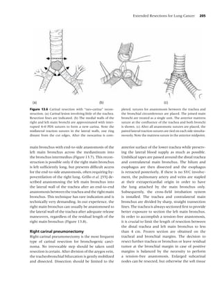 Extended Resections for Lung Cancer              205




 (a)                                               (b)                                          (c)
Figure 13.6 Carinal resection with “neo-carina” recon-           pleted, sutures for anastomosis between the trachea and
struction. (a) Carinal lesion involving little of the trachea.   the bronchial circumference are placed. The joined main
Resection lines are indicated. (b) The medial walls of the       bronchi are treated as a single unit. The anterior mattress
right and left main bronchi are approximated with inter-         suture at the conﬂuence of the trachea and both bronchi
rupted 4–0 PDS sutures to form a new carina. Note the            is shown. (c) After all anastomotic sutures are placed, the
midlateral traction sutures in the lateral walls, one ring       paired lateral traction sutures are tied on each side simulta-
distant from the cut edges. After the neocarina is com-          neously. Note the mattress suture in the anterior midpoint.


main bronchus with end-to-side anastomosis of the                anterior surface of the lower trachea while preserv-
left main bronchus across the mediastinum into                   ing the lateral blood supply as much as possible.
the bronchus intermedius (Figure 13.7). This recon-              Umbilical tapes are passed around the distal trachea
struction is possible only if the right main bronchus            and contralateral main bronchus. The hilum and
is left sufﬁciently long, but presents difﬁcult access           esophagus are then dissected and the esophagus
for the end-to-side anastomosis, often requiring hy-             is retracted posteriorly. If there is no SVC involve-
poventilation of the right lung. Grillo et al. [55] de-          ment, the pulmonary artery and veins are stapled
scribed anastomosing the left main bronchus into                 at their extrapericardial origin in order to have
the lateral wall of the trachea after an end-to-end              the lung attached by the main bronchus only.
anastomosis between the trachea and the right main               Subsequently, the cross-ﬁeld intubation system
bronchus. This technique has rare indication and is              is installed. The trachea and contralateral main
technically very demanding. In our experience, the               bronchus are divided by sharp, straight transection
right main bronchus can usually be anastomosed to                lines. The trachea is always sectioned ﬁrst to provide
the lateral wall of the trachea after adequate release           better exposure to section the left main bronchus.
maneuvers, regardless of the residual length of the              In order to accomplish a tension-free anastomosis,
right main bronchus (Figure 13.8).                               it is crucial to limit the length of resection between
                                                                 the distal trachea and left main bronchus to less
Right carinal pneumonectomy                                      than 4 cm. Frozen section are obtained on the
Right carinal pneumonectomy is the most frequent                 tracheal and bronchial margins. The decision to
type of carinal resection for bronchogenic carci-                resect further trachea or bronchus or leave residual
noma. No irrevocable step should be taken until                  tumor at the bronchial margin in case of positive
resection is certain. After division of the azygos vein,         margins is balanced by the necessity to perform
the tracheobronchial bifurcation is gently mobilized             a tension-free anastomosis. Enlarged subcarinal
and dissected. Dissection should be limited to the               nodes can be resected, but otherwise the soft tissue
 