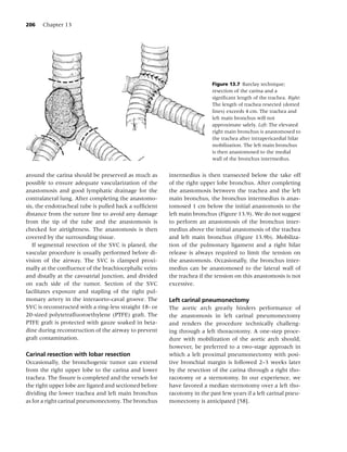 206   Chapter 13




                                                                         Figure 13.7 Barclay technique;
                                                                         resection of the carina and a
                                                                         signiﬁcant length of the trachea. Right:
                                                                         The length of trachea resected (dotted
                                                                         lines) exceeds 4 cm. The trachea and
                                                                         left main bronchus will not
                                                                         approximate safely. Left: The elevated
                                                                         right main bronchus is anastomosed to
                                                                         the trachea after intrapericardial hilar
                                                                         mobilization. The left main bronchus
                                                                         is then anastomosed to the medial
                                                                         wall of the bronchus intermedius.


around the carina should be preserved as much as        intermedius is then transected below the take off
possible to ensure adequate vascularization of the      of the right upper lobe bronchus. After completing
anastomosis and good lymphatic drainage for the         the anastomosis between the trachea and the left
contralateral lung. After completing the anastomo-      main bronchus, the bronchus intermedius is anas-
sis, the endotracheal tube is pulled back a sufﬁcient   tomosed 1 cm below the initial anastomosis to the
distance from the suture line to avoid any damage       left main bronchus (Figure 13.9). We do not suggest
from the tip of the tube and the anastomosis is         to perform an anastomosis of the bronchus inter-
checked for airtightness. The anastomosis is then       medius above the initial anastomosis of the trachea
covered by the surrounding tissue.                      and left main bronchus (Figure 13.9b). Mobiliza-
   If segmental resection of the SVC is planed, the     tion of the pulmonary ligament and a right hilar
vascular procedure is usually performed before di-      release is always required to limit the tension on
vision of the airway. The SVC is clamped proxi-         the anastomosis. Occasionally, the bronchus inter-
mally at the conﬂuence of the brachiocephalic veins     medius can be anastomosed to the lateral wall of
and distally at the cavoatrial junction, and divided    the trachea if the tension on this anastomosis is not
on each side of the tumor. Section of the SVC           excessive.
facilitates exposure and stapling of the right pul-
monary artery in the interaorto-caval groove. The       Left carinal pneumonectomy
SVC is reconstructed with a ring-less straight 18- or   The aortic arch greatly hinders performance of
20-sized polytetraﬂuoroethylene (PTFE) graft. The       the anastomosis in left carinal pneumonectomy
PTFE graft is protected with gauze soaked in beta-      and renders the procedure technically challeng-
dine during reconstruction of the airway to prevent     ing through a left thoracotomy. A one-step proce-
graft contamination.                                    dure with mobilization of the aortic arch should,
                                                        however, be preferred to a two-stage approach in
Carinal resection with lobar resection                  which a left proximal pneumonectomy with posi-
Occasionally, the bronchogenic tumor can extend         tive bronchial margin is followed 2–3 weeks later
from the right upper lobe to the carina and lower       by the resection of the carina through a right tho-
trachea. The ﬁssure is completed and the vessels for    racotomy or a sternotomy. In our experience, we
the right upper lobe are ligated and sectioned before   have favored a median sternotomy over a left tho-
dividing the lower trachea and left main bronchus       racotomy in the past few years if a left carinal pneu-
as for a right carinal pneumonectomy. The bronchus      monectomy is anticipated [58].
 