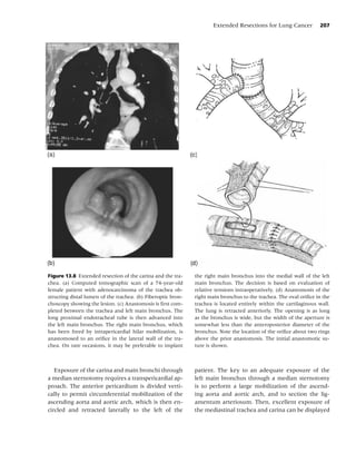 Extended Resections for Lung Cancer           207




Figure 13.8 Extended resection of the carina and the tra-     the right main bronchus into the medial wall of the left
chea. (a) Computed tomographic scan of a 74-year-old          main bronchus. The decision is based on evaluation of
female patient with adenocarcinoma of the trachea ob-         relative tensions intraoperatively. (d) Anastomosis of the
structing distal lumen of the trachea. (b) Fiberoptic bron-   right main bronchus to the trachea. The oval oriﬁce in the
choscopy showing the lesion. (c) Anastomosis is ﬁrst com-     trachea is located entirely within the cartilaginous wall.
pleted between the trachea and left main bronchus. The        The lung is retracted anteriorly. The opening is as long
long proximal endotracheal tube is then advanced into         as the bronchus is wide, but the width of the aperture is
the left main bronchus. The right main bronchus, which        somewhat less than the anteroposterior diameter of the
has been freed by intrapericardial hilar mobilization, is     bronchus. Note the location of the oriﬁce about two rings
anastomosed to an oriﬁce in the lateral wall of the tra-      above the prior anastomosis. The initial anastomotic su-
chea. On rare occasions, it may be preferable to implant      ture is shown.



   Exposure of the carina and main bronchi through            patient. The key to an adequate exposure of the
a median sternotomy requires a transpericardial ap-           left main bronchus through a median sternotomy
proach. The anterior pericardium is divided verti-            is to perform a large mobilization of the ascend-
cally to permit circumferential mobilization of the           ing aorta and aortic arch, and to section the lig-
ascending aorta and aortic arch, which is then en-            amentum arteriosum. Then, excellent exposure of
circled and retracted laterally to the left of the            the mediastinal trachea and carina can be displayed
 