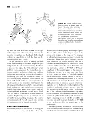 208    Chapter 13




                                                                            Figure 13.9 Carinal resection with
                                                                            lobar resection. (a) A right upper lobe
                                                                            tumor extending to the carina and
                                                                            lower trachea. (b) An anastomosis of
                                                                            the bronchus intermedius above the
                                                                            initial anastomosis of the trachea and
                                                                            left main bronchus is not suggested.
                                                                            (c) Following the anastomosis
                                                                            between the trachea and the left main
                                                                            bronchus, the bronchus intermedius is
                                                                            anastomosed 1 cm below the initial
                                                                            anastomosis.



by encircling and retracting the SVC to the right         technique consists in applying a running 4/0 poly-
and the right main pulmonary artery inferiorly. The       diaxone (PDS) suture on the deepest aspect of the
posterior pericardium can then be divided vertically      airway with respect to the surgeon. For instance,
to improve accessibility to both the right and left       in right carinal pneumonectomy, this represents the
main bronchi (Figure 13.10).                              left aspect of the cartilage wall of the trachea and left
   The left mediastinal pleura is opened anteriorly       main bronchus. The running suture is then tied at
below the sternal edge to access the left pleural space   each end with two independent PDS sutures whose
and perform the left pneumonectomy. The hilum             knots are made outside the lumen. Thereafter, sev-
is dissected to expose the left pulmonary artery          eral interrupted stitches of 3/0 PDS or 3/0 vicryl
and both pulmonary veins. The pericardium can be          are placed in the remaining part of the anastomo-
opened anteriorly and posteriorly around the hilum        sis. They are tied after all of them have been placed
to improve exposure and facilitate stapling of both       to correct for size discrepancies. The stitches applied
pulmonary veins and the pulmonary artery. The             on the membranous portion are tied at the end to
pericardial opening should be limited around the          avoid any traction and potential tears. If an end-to-
hilum and closed at the end of the procedure to           side anastomosis is required, the lateral side of the
avoid luxation of the heart into the left chest. The      trachea is opened in an ovoid fashion correspond-
left lung can then be removed after transecting the       ing to the size of the bronchus to be implanted. The
distal trachea and right main bronchus. An end-           opening is performed at least 1 cm away from the
to-end anastomosis between the trachea and right          ﬁrst anastomosis and is placed on the cartilaginous
main bronchus is performed. The left pleura should        part of the trachea or bronchus to avoid any devas-
then be closed in order to contain ﬂuid accumula-         cularization of the initial anastomosis and to provide
tion into the pleural space. The anastomosis can be       additional rigidity to the end-to-side anastomosis.
covered with surrounding tissue and the anterior          Again, a running suture of 4/0 PDS is used for the
pericardium closed. The left pleural space and the        posterior part and interrupted stitches of 3/0 PDS
pericardium should be drained separately.                 or 3/0 vicryl are used for the anterior part of the
                                                          anastomosis.
Anastomotic technique                                        The development of anastomotic complications is
The tracheobronchial anastomosis is usually per-          likely due to technical factors at the time of airway
formed in an end-to-end fashion ﬁrst. Our                 resection and reconstruction. Careful dissection and
 