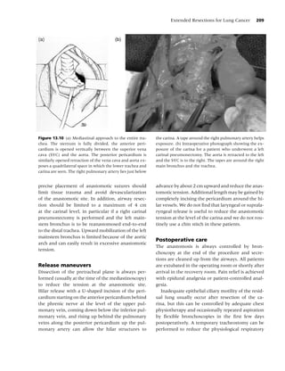 Extended Resections for Lung Cancer           209




Figure 13.10 (a) Mediastinal approach to the entire tra-      the carina. A tape around the right pulmonary artery helps
chea. The sternum is fully divided, the anterior peri-        exposure. (b) Intraoperative photograph showing the ex-
cardium is opened vertically between the superior vena        posure of the carina for a patient who underwent a left
cava (SVC) and the aorta. The posterior pericardium is        carinal pneumonectomy. The aorta is retracted to the left
similarly opened retraction of the vena cava and aorta ex-    and the SVC is to the right. The tapes are around the right
poses a quadrilateral space in which the lower trachea and    main bronchus and the trachea.
carina are seen. The right pulmonary artery lies just below


precise placement of anastomotic sutures should               advance by about 2 cm upward and reduce the anas-
limit tissue trauma and avoid devascularization               tomotic tension. Additional length may be gained by
of the anastomotic site. In addition, airway resec-           completely incising the pericardium around the hi-
tion should be limited to a maximum of 4 cm                   lar vessels. We do not ﬁnd that laryngeal or suprala-
at the carinal level, in particular if a right carinal        ryngeal release is useful to reduce the anastomotic
pneumonectomy is performed and the left main-                 tension at the level of the carina and we do not rou-
stem bronchus is to be reanastomosed end-to-end               tinely use a chin stitch in these patients.
to the distal trachea. Upward mobilization of the left
mainstem bronchus is limited because of the aortic
                                                              Postoperative care
arch and can easily result in excessive anastomotic
                                                              The anastomosis is always controlled by bron-
tension.
                                                              choscopy at the end of the procedure and secre-
                                                              tions are cleaned up from the airways. All patients
Release maneuvers                                             are extubated in the operating room or shortly after
Dissection of the pretracheal plane is always per-            arrival in the recovery room. Pain relief is achieved
formed (usually at the time of the mediastinoscopy)           with epidural analgesia or patient-controlled anal-
to reduce the tension at the anastomotic site.                gesia.
Hilar release with a U-shaped incision of the peri-              Inadequate epithelial ciliary motility of the resid-
cardium starting on the anterior pericardium behind           ual lung usually occur after resection of the ca-
the phrenic nerve at the level of the upper pul-              rina, but this can be controlled by adequate chest
monary vein, coming down below the inferior pul-              physiotherapy and occasionally repeated aspiration
monary vein, and rising up behind the pulmonary               by ﬂexible bronchoscopies in the ﬁrst few days
veins along the posterior pericardium up the pul-             postoperatively. A temporary tracheostomy can be
monary artery can allow the hilar structures to               performed to reduce the physiological respiratory
 