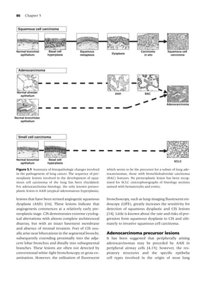 86    Chapter 5


  Squamous cell carcinoma




 Normal bronchial      Basal cell           Squamous                                Carcinoma         Squamous cell
    epithelium        hyperplasia           metaplasia          Dysplasia             in situ           carcinoma




  Adenocarcinoma




 Normal alveolar                                                  AAH                  BAC
   epithelium


                                                                                                      Adenocarcinoma



Normal bronchiolar
    epithelium




  Small cell carcinoma




 Normal bronchial      Basal cell
                                                                                                           SCLC
    epithelium        hyperplasia

 Figure 5.1 Summary of histopathologic changes involved      which seems to be the precursor for a subset of lung ade-
 in the pathogenesis of lung cancer. The sequence of pre-    nocarcinomas, those with bronchioloalveolar carcinoma
 neoplastic lesions involved in the development of squa-     (BAC) features. No preneoplastic lesion has been recog-
 mous cell carcinoma of the lung has been elucidated.        nized for SCLC (microphotographs of histology sections
 For adenocarcinoma histology, the only known preneo-        stained with hematoxylin and eosin).
 plastic lesion is AAH (atypical adenomatous hyperplasia),

 lesions that have been termed angiogenic squamous           bronchoscopy, such as lung-imaging ﬂuorescent en-
 dysplasia (ASD) [16]. These lesions indicate that           doscopy (LIFE), greatly increases the sensitivity for
 angiogenesis commences at a relatively early pre-           detection of squamous dysplastic and CIS lesions
 neoplastic stage. CIS demonstrates extreme cytolog-         [14]. Little is known about the rate and risks of pro-
 ical aberrations with almost complete architectural         gression from squamous dysplasia to CIS and ulti-
 disarray, but with an intact basement membrane              mately to invasive squamous cell carcinoma.
 and absence of stromal invasion. Foci of CIS usu-
 ally arise near bifurcations in the segmental bronchi,      Adenocarcinoma precursor lesions
 subsequently extending proximally into the adja-            It has been suggested that peripherally arising
 cent lobar bronchus and distally into subsegmental          adenocarcinomas may be preceded by AAH in
 branches. These lesions are often not detected by           peripheral airway cells [4,15]; however, the res-
 conventional white-light bronchoscopy or gross ex-          piratory structures and the speciﬁc epithelia
 amination. However, the utilization of ﬂuorescent           cell types involved in the origin of most lung
 