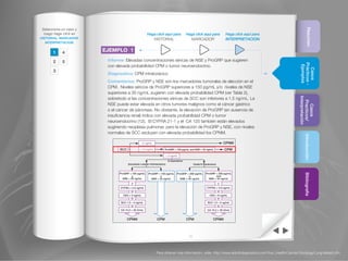 Para obtener más información, visite http://www.abbottdiagnostics.com/Your_Health/Cancer-Oncology/Lung/default.cfm
Resumen
Casos
Prácticos-
Ejemplos
Casos
Practicos/
Interpretación
IntroducciónBibliografía
16
Seleccione un caso y
luego haga click en
HISTORIAL, MARCADOR,
INTERPRETACION.
4
5
1
2
3
Haga click aquí para
HISTORIAL
Haga click aquí para
MARCADOR
Haga click aquí para
INTERPRETACION
CPNM CPNM
CPNM
CPM CPM
CPMSCC
2 ng/mL
Desconocido o estadío I-III (Intratorácico)
Si sospechamos
Estadío IV (Extratorácico)
ProGRP  100 pg/mL
y
NSE  30 ng/mL
CYFRA  3.3 ng/mL CYFRA  4.9 ng/mL
CEA  8 ng/mL
SCC 1.5 – 2 ng/mL
CA 15.3  35 U/mL
CEA  5 ng/mL
SCC 1.5 – 2 ng/mL
CA 15.3  35 U/mL
ProGRP  150 pg/mL
o
NSE  35 ng/mL
ProGRP  200 pg/mL
o
NSE  45 ng/mL
ProGRP  200 pg/mL
and
NSE  45 ng/mL
 1.5 ng/mL
 2 ng/mL
ProGRP  100 pg/mL and NSE  30 ng/mL
y y
o o
o o
o o
EJEMPLO 1
Informe: Elevadas concentraciones séricas de NSE y ProGRP que sugieren
con elevada probabilidad CPM o tumor neuroendocrino.
Diagnostico: CPM intratorácico
Comentarios: ProGRP y NSE son los marcadores tumorales de elección en el
CPM. Niveles séricos de ProGRP superiores a 150 pg/mL y/o niveles de NSE
superiores a 35 ng/mL sugieren con elevada probabilidad CPM (ver Tabla 2),
sobretodo si las concentraciones séricas de SCC son inferiores a 1.5 ng/mL. La
NSE puede estar elevada en otros tumores malignos como el cáncer gástrico
o el cáncer de páncreas. No obstante, la elevación de ProGRP (en ausencia de
insuficiencia renal) indica con elevada probabilidad CPM o tumor
neuroendocrino (12). El CYFRA 21-1 y el CA 125 también están elevados
sugiriendo neoplasia pulmonar, pero la elevación de ProGRP y NSE, con niveles
normales de SCC excluyen con elevada probabilidad los CPNM.
1
 