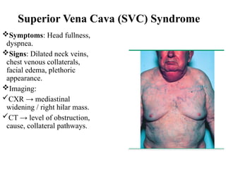 Svc. Sign lung carcinoma Power point presentation | PPTX