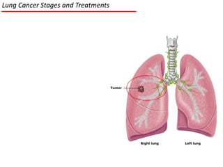 Lung Cancer Stages, Treatments and Targeted Therapies | PPTX
