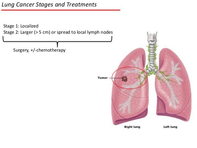 Lung Lung