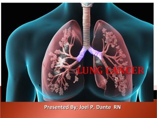 Lung cancer ll | PPT