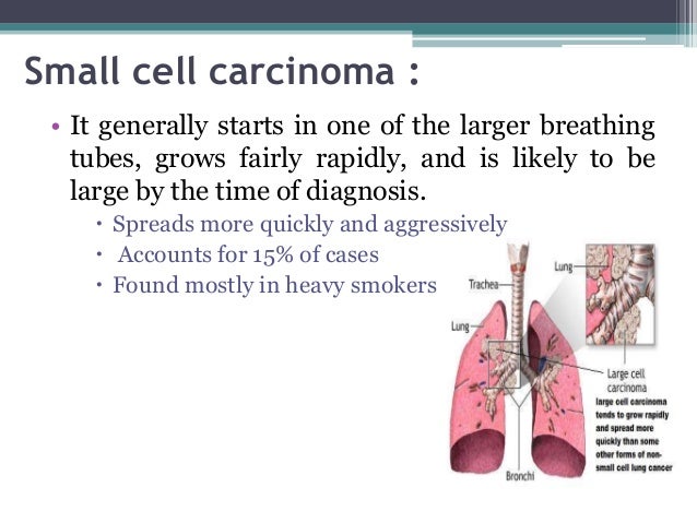 Lung Cancer Ppt