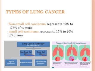 Comprehensive Overview of Lung Cancer: Types, Diagnosis, and Treatment ...