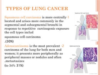 Comprehensive Overview of Lung Cancer: Types, Diagnosis, and Treatment ...
