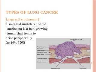 Comprehensive Overview of Lung Cancer: Types, Diagnosis, and Treatment ...