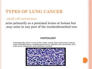 Comprehensive Overview of Lung Cancer: Types, Diagnosis, and Treatment ...