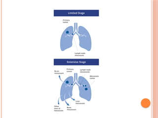 Comprehensive Overview of Lung Cancer: Types, Diagnosis, and Treatment ...