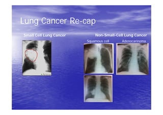 Lung Cancer Re-cap
Small Cell Lung Cancer Non-Small-Cell Lung Cancer
Squamous cell Adenocarinoma
 