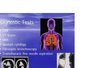 Diagnostic Tests
• CXR
• CT Scans
• MRI
• Sputum cytology
• Fibreoptic bronchoscopy
• Transthoracic fine needle aspiration
 