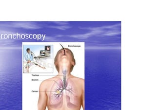 Bronchoscopy
 