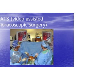 VATS (video assisted
horacoscopic surgery)
 