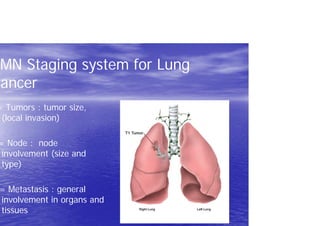 TMN Staging system for Lung
Cancer
= Tumors : tumor size,
(local invasion)
= Node : node
involvement (size and
type)
= Metastasis : general
involvement in organs and
tissues
 