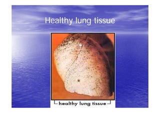 Healthy lung tissue
 