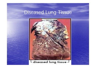 Diseased Lung Tissue
 