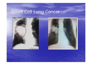 Small Cell Lung Cancer
 