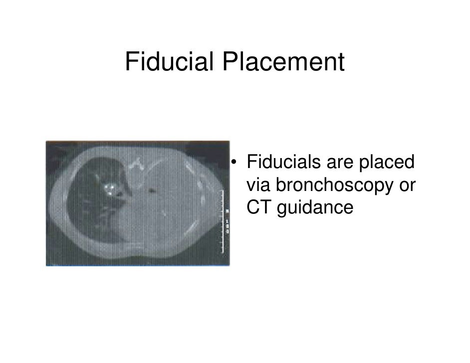 Lung Cancer Radiosurgery