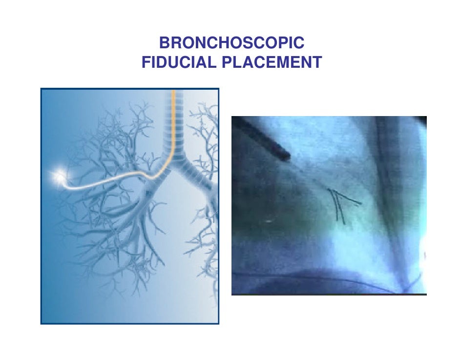 Lung Cancer Radiosurgery