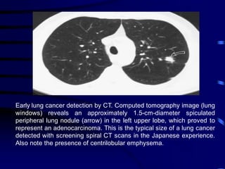 Early lung cancer detection by CT. Computed tomography image (lung
windows) reveals an approximately 1.5-cm-diameter spiculated
peripheral lung nodule (arrow) in the left upper lobe, which proved to
represent an adenocarcinoma. This is the typical size of a lung cancer
detected with screening spiral CT scans in the Japanese experience.
Also note the presence of centrilobular emphysema.
 