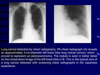 Lung cancer detection by chest radiography. PA chest radiograph (A) reveals
an approximately 3-cm-diameter left lower lobe lung nodule (arrow), which
proved to represent an adenocarcinoma. The nodule is seen in better detail
on the coned-down image of the left lower lobe in B. This is the typical size of
a lung cancer detected with screening chest radiographs in the Japanese
experience.
 