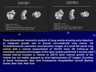 A
B
Three-dimensional volumetric analysis of lung nodule showing early detection
of malignant growth rate in proven non-small-cell lung cancer. (A)
Threedimensional volumetric reconstruction images of a small left apical lung
nodule with a volume measurement of 193.531 mm3. (B) Follow-up 3D
volumetric reconstructionimages of the same nodule performed 4 months later
reveals interval increase in volume to 239.75 mm3. Interval growth of the
nodule was not readily apparent on axial highresolution CT images. (Courtesy
of David Yankelevitz, New York Presbyterian Hospital/Weil Cornell Medical
Center, New York, New York
 