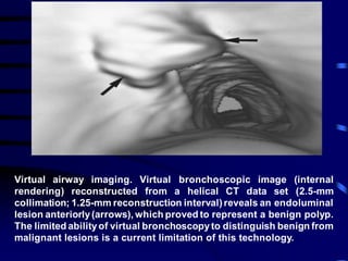 Virtual airway imaging. Virtual bronchoscopic image (internal
rendering) reconstructed from a helical CT data set (2.5-mm
collimation; 1.25-mm reconstruction interval)reveals an endoluminal
lesion anteriorly(arrows), which proved to represent a benign polyp.
The limited abilityof virtual bronchoscopyto distinguish benign from
malignant lesions is a current limitation of this technology.
 
