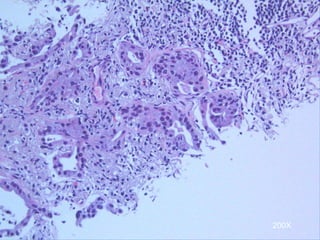 Low Dose CT Screening for Early Diagnosis of Lung Cancer | PPTX