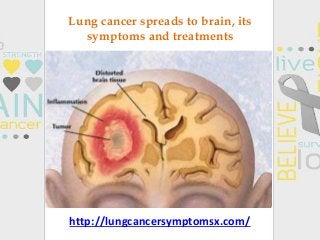 Lung cancer spreads to brain, its
symptoms and treatments
http://lungcancersymptomsx.com/
 