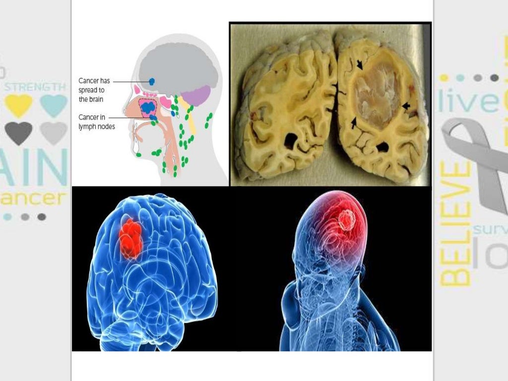 Lung cancer spreads to brain and its symptoms