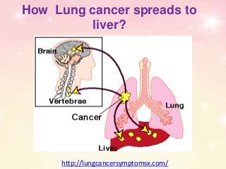 How Lung cancer spreads to
liver?
http://lungcancersymptomsx.com/
 