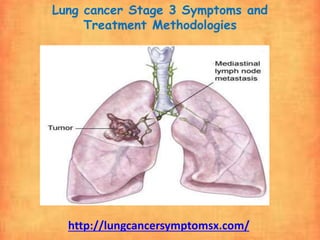 Lung cancer Stage 3 Symptoms and
Treatment Methodologies
http://lungcancersymptomsx.com/
 