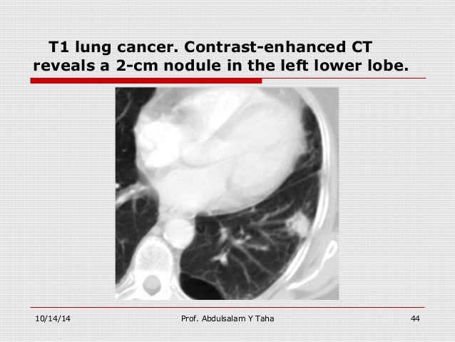 Abdulsalam Y Taha 43 44 T1 Lung Cancer Abdulsalam Y Taha 43 44 T1 Lung Cancer