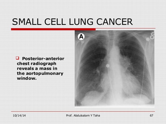 Lung cancer staging the noninvasive tools