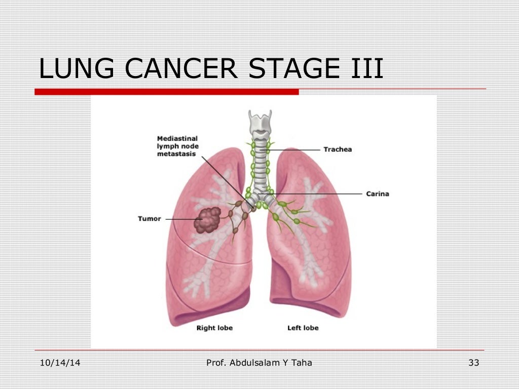 Staging Of Lung Cancer Chart