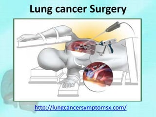 Lung cancer Surgery
http://lungcancersymptomsx.com/
 