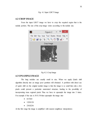 32
Fig: 4.1 Input LDCT Image
4.2 CROP IMAGE
From the input LDCT image we have to crop the required region that is the
nodule portion. The size of the crop image varies according to the nodule size.
Fig 4.2: Crop Image
4.3 UPSAMPLE IMAGE
The lung nodules are usually small in size. When we apply Quick shift
algorithm directly into an image poor partition will obtained. A problem with direct use
of quick shift on the original nodule image is that the image is so small that only a few
pixels could present a particular anatomical structure, leading to the possibility of
incorporating trans regional pixels Thus we have to upsample the image into 3 times.
For example if the size is 30 X 30 then upsample the image into
 64 X64
 128X128
 256X256
At the first stage the image is amplified with nearest neighbour interpolation
 