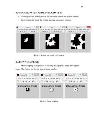 34
4.5 NODULE PATCH AND LEVEL CONTEXT
 Nodule patch-the nodule patch is the patch that contains the nodule centroid
 Level context-the patch that contain surround anatomical structure
Fig 4.5: Nodule patch and level context
4.6 DOWN SAMPLING
Down sampling is the process of restoring the superpixel image into original
image. The clusters are thus the desired image patches
Fig 4.6: Down sampling
 