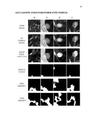 36
4.8 CLASSIFICATION FOR OTHER TYPE NODULE
V JPN
CROP
IMAGE
UP
SAMPLE
IMAGE
SUPER
PIXEL
FORMULATION
NODULE
PATCH
LEVEL
CONTEXT 1
LEVEL
CONTEXT 2
 
