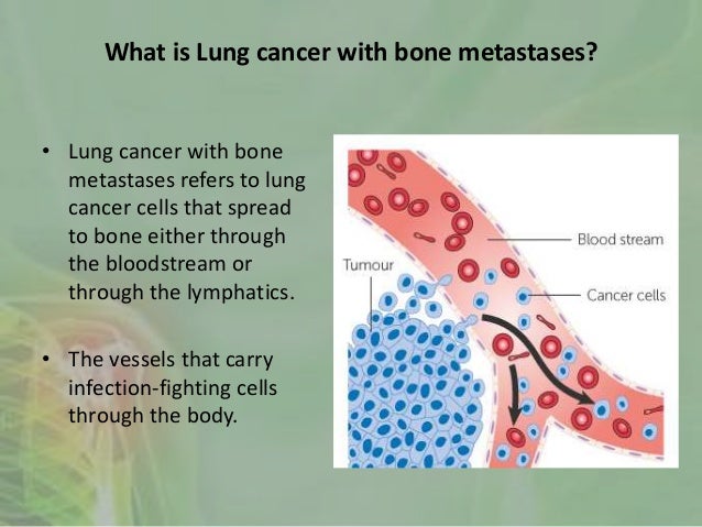 lung cancer sx lung cancer with bone metastases