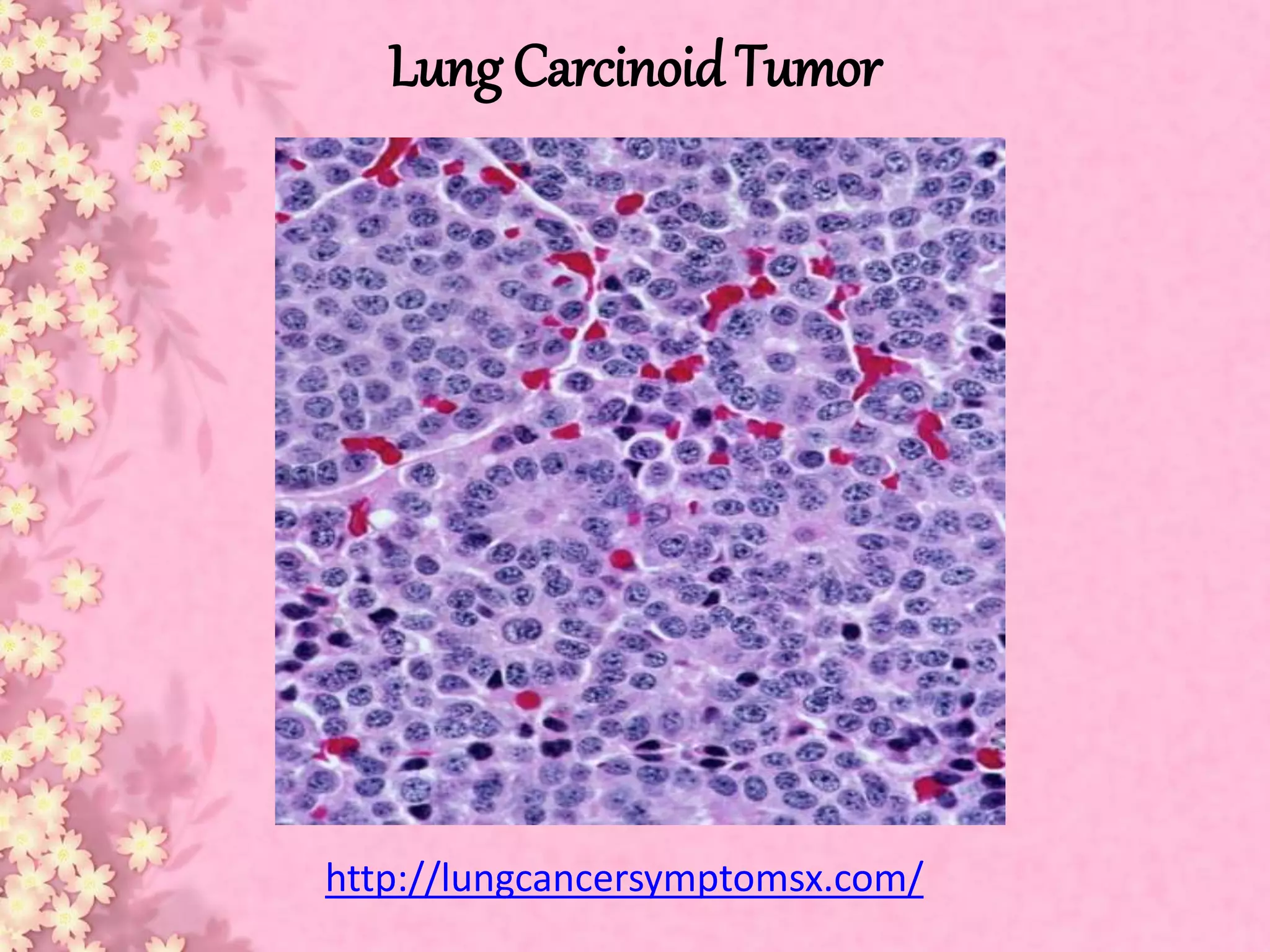 Lung carcinoid tumor | PPTX