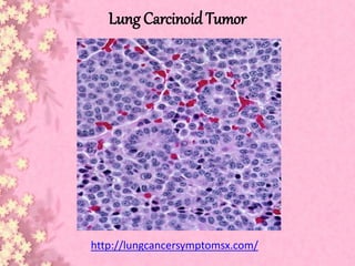 Lung Carcinoid Tumor
http://lungcancersymptomsx.com/
 
