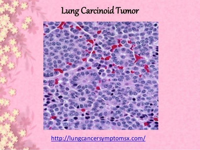 Lung carcinoid tumor