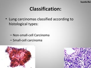 Sayantika Dhar


              Classification:
• Lung carcinomas classified according to
  histological types:

  – Non-small-cell Carcinoma
  – Small-cell carcinoma
 