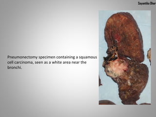 Sayantika Dhar




Pneumonectomy specimen containing a squamous
cell carcinoma, seen as a white area near the
bronchi.
 
